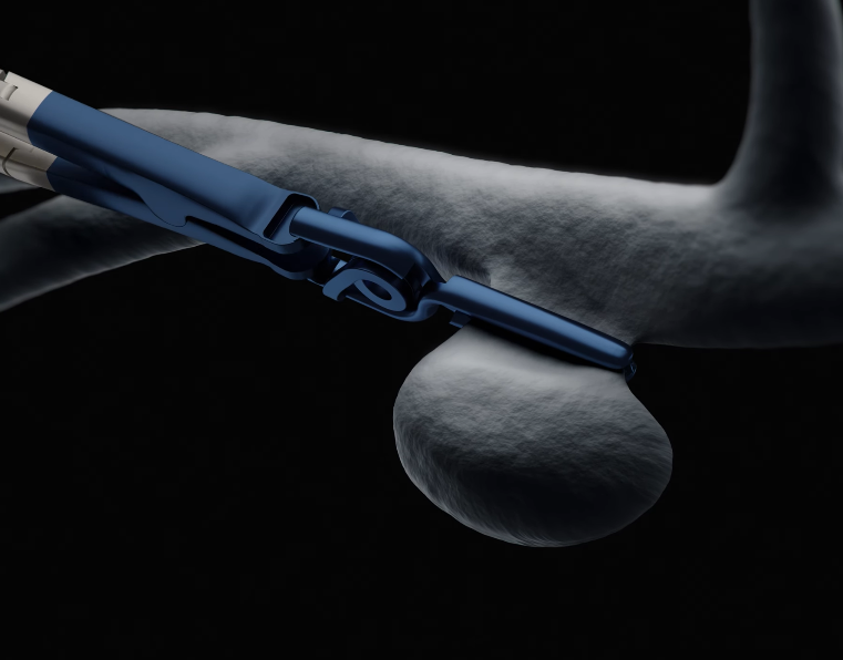 Perneczky Aneurysm Clip 2